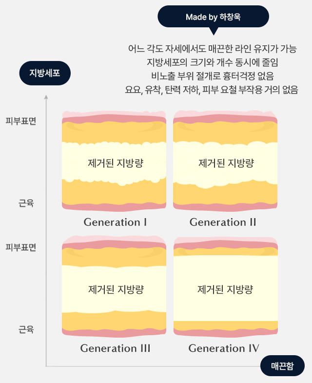 완성된 지방흡입